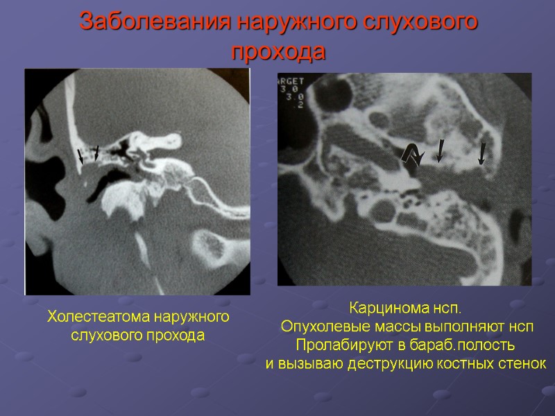 Заболевания наружного слухового прохода Холестеатома наружного слухового прохода Карцинома нсп.  Опухолевые массы выполняют